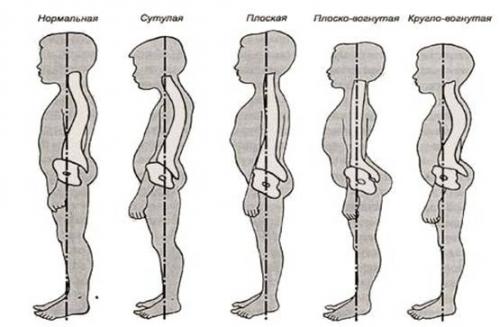 Может ли растяжка улучшить осанку. Растяжка уберет сутулость?