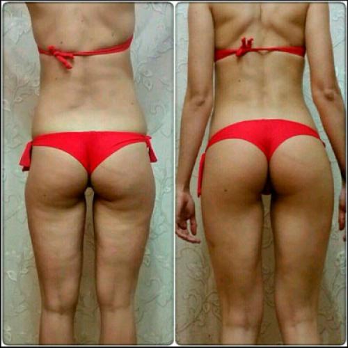 Какие факторы могут способствовать появлению складки под ягодицами. Главные причины появления складок под ягодицами