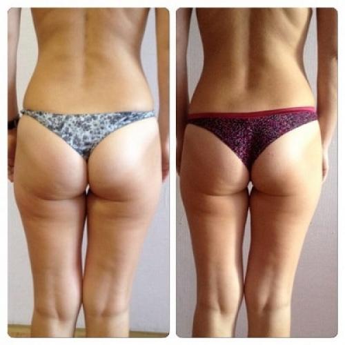 Что такое складка под ягодицами и почему она появляется. Причины