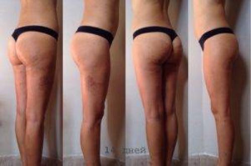 Похудеть и избавиться от складки под ягодицами: проверенные методы 09
