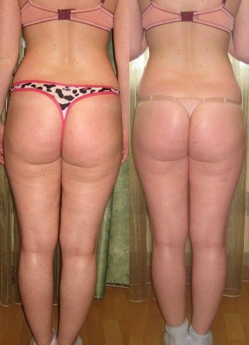 Что такое складка под ягодицами и почему она появляется. Причины