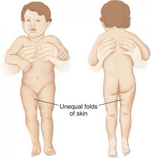 Что такое складка под ягодицами и почему она появляется. Причины