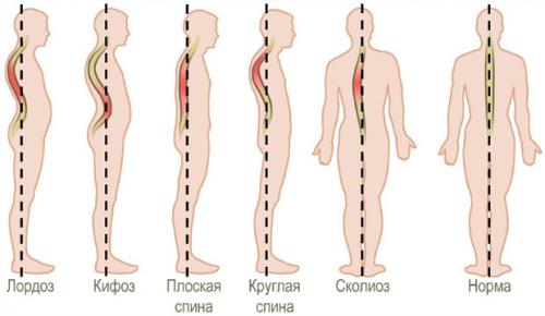 Упражнения для исправления осанки у детей. ЛФК для детей с нарушением осанки в картинках