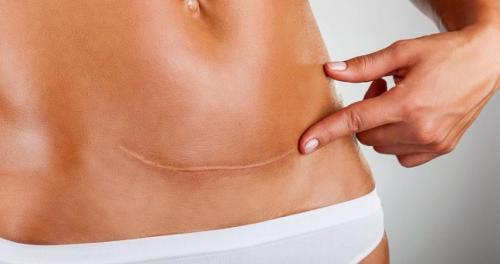 Как вернуться к занятиям спортом после кесарева секции: советы и рекомендации 03