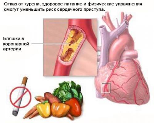 Как избежать срывов и соблюдать график здорового образа жизни на протяжении долгого времени. Что такое стенокардия?