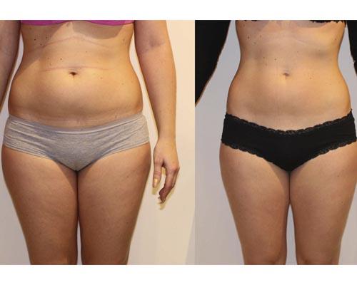 Секреты быстрого восстановления фигуры после беременности: как убрать живот и растяжки 10 Секреты быстрого восстановления фигуры после беременности: как убрать живот и растяжки 10