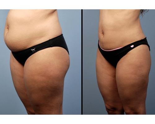 Секреты быстрого восстановления фигуры после беременности: как убрать живот и растяжки 09 Секреты быстрого восстановления фигуры после беременности: как убрать живот и растяжки 09