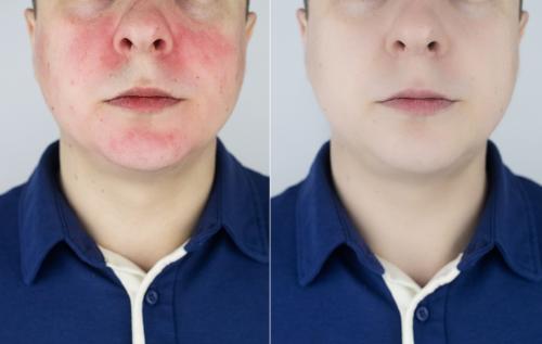 Проблемные кожи: как правильно питаться для здоровья кожи 04 Проблемные кожи: как правильно питаться для здоровья кожи 04